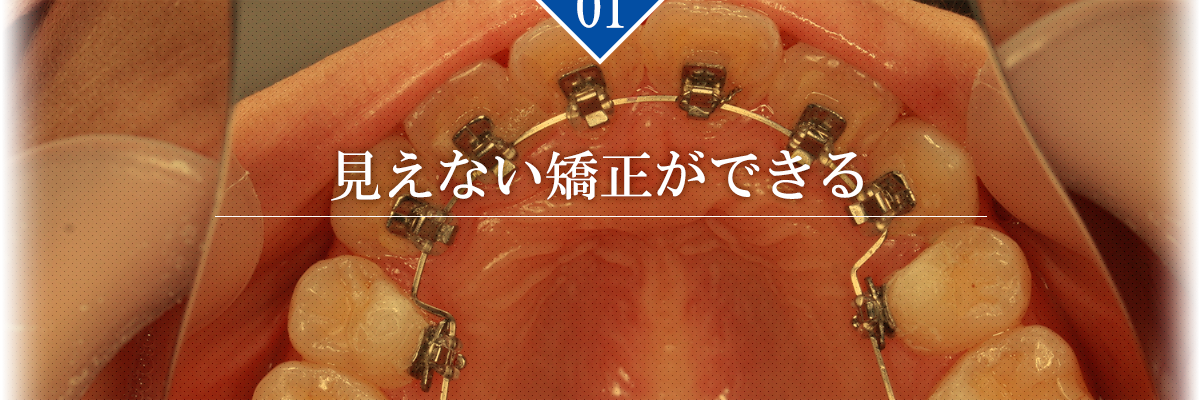 【理由1】見えない矯正ができる